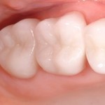 dental-crowns-after-brian-novak