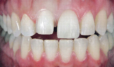 dental_veneers_before dental_veneers_before